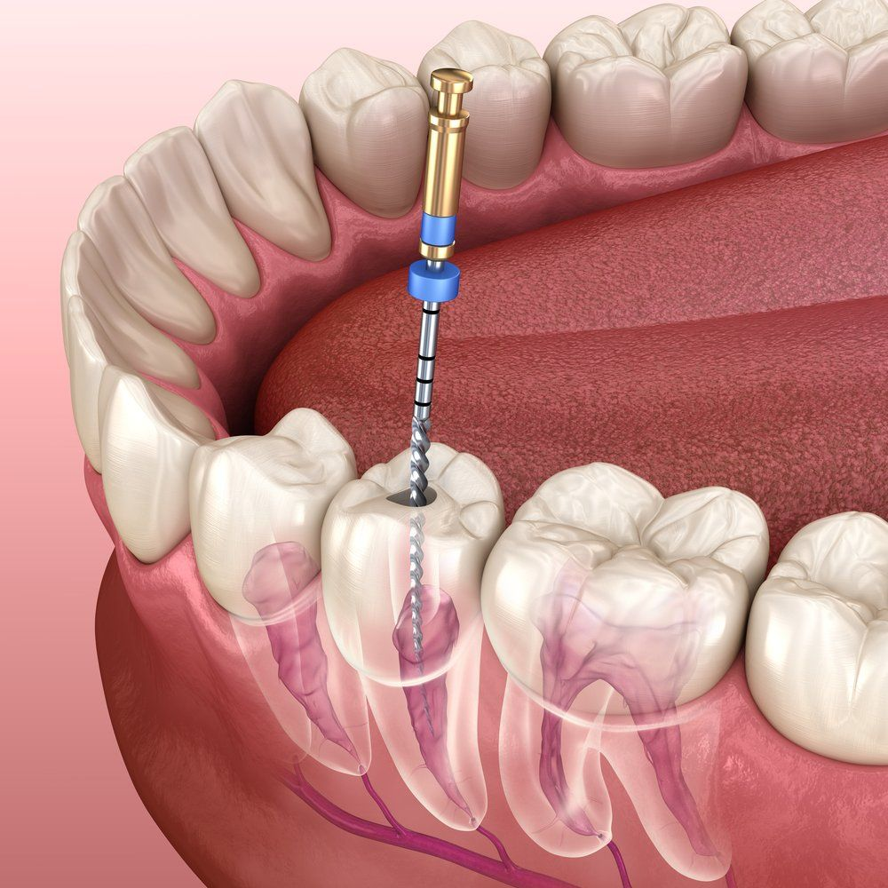 Root Canal Treatment at Lebanon Dental Care Clinic in Mombasa, Kenya