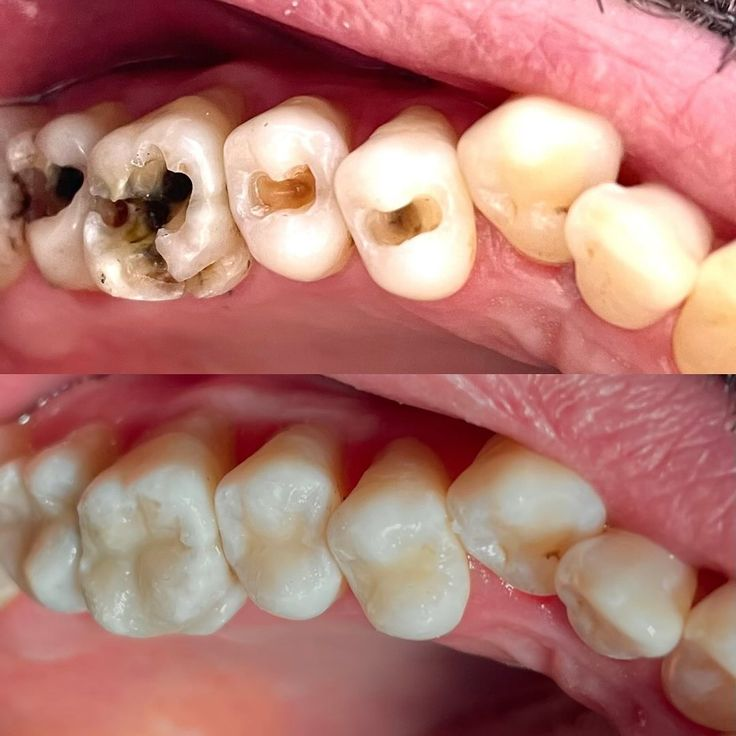 Teeth Filling at Lebanon Dental Care Clinic in Mombasa, Kenya
