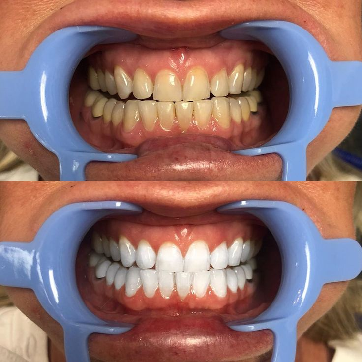 Teeth Whitening before and after results at Lebanon Dental Care Clinic, Mombasa