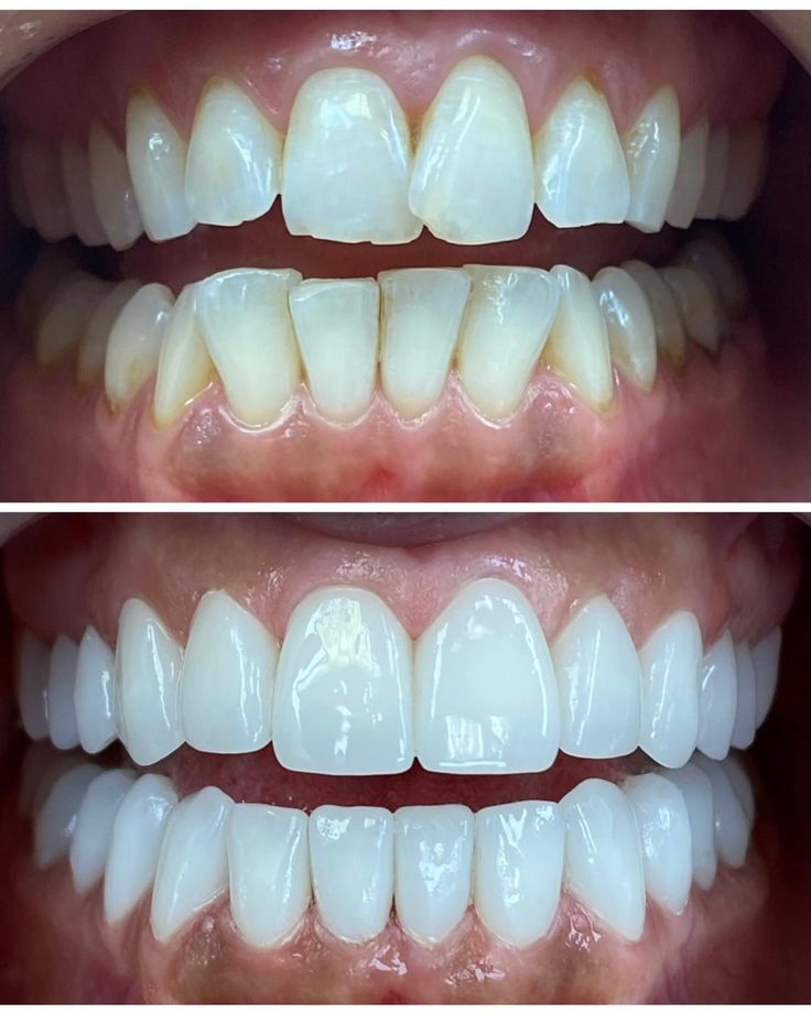 Veneers before and after results at Lebanon Dental Care Clinic, Mombasa