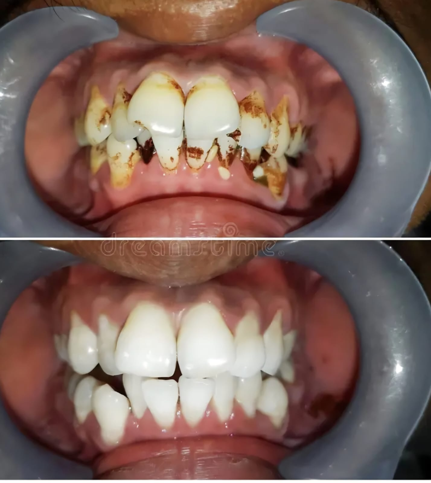 Teeth Cleaning at Lebanon Dental Care Clinic in Mombasa, Kenya