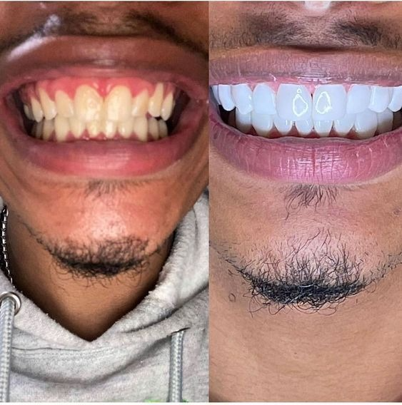 Teeth Masking at Lebanon Dental Care Clinic in Mombasa, Kenya